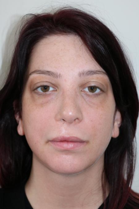 After image 1 Case #123116 - Late Cleft Lip Nasal Deformity 