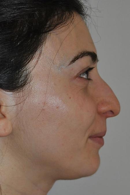 Before image 4 Case #122636 - Aestetic Reduction Rhinoseptoplasty