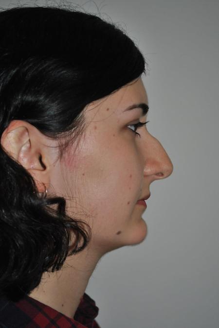 Before image 4 Case #122746 - Rhinoseptoplasty