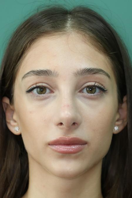 After image 1 Case #122801 - Reduction Rhinoseptoplasty