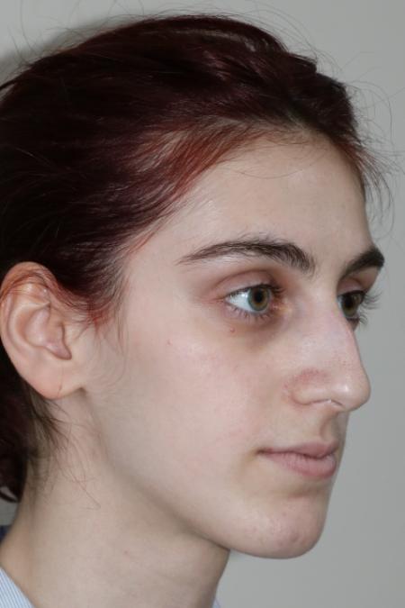 Before image 3 Case #122786 - Aesthetic Reduction Rhinoseptoplasty