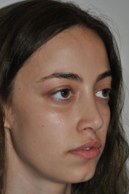 After image 2 Case #122641 - Aesthetic Reduction Rhinoseptoplasty