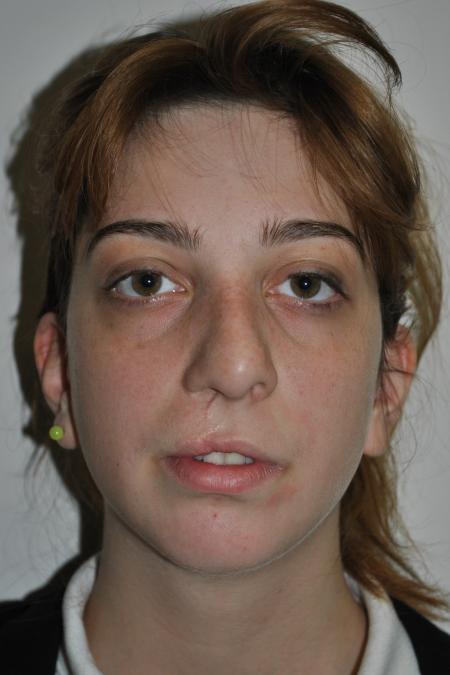 Before image 1 Case #123116 - Late Cleft Lip Nasal Deformity 