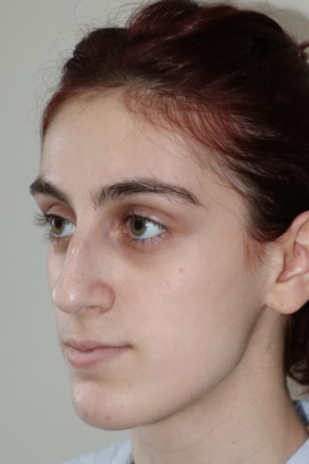 Before image 2 Case #122786 - Aesthetic Reduction Rhinoseptoplasty
