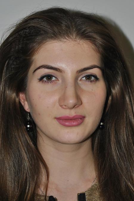 After image 1 Case #122771 - Aesthetic Reduction Rhinoplasty