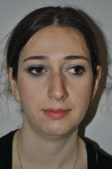 Before image 1 Case #122736 - Hybrid Rhinoplasty