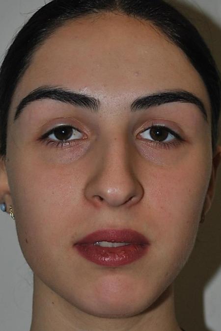 Before image 1 Case #122621 - Aesthetic Reduction Rhinoseptoplasty