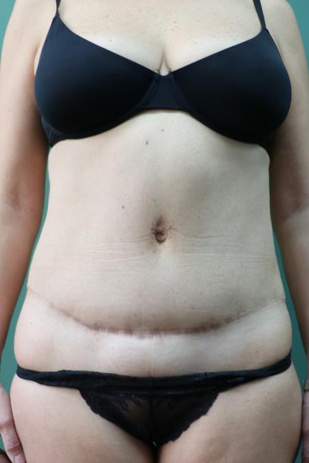 After image 1 Case #122761 - Traditional Abdominoplasty