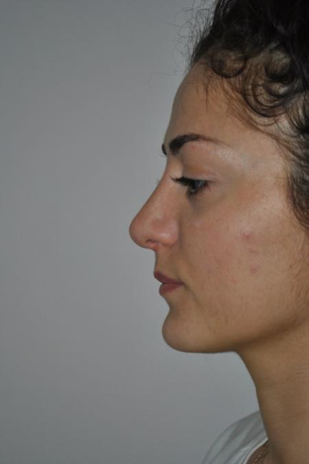 After image 5 Case #122741 - Primary Rhinoseptoplasty, Turbinate Lateralization
