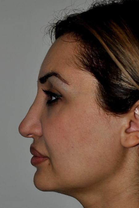 Before image 5 Case #122601 - Aging Rhinoplasty