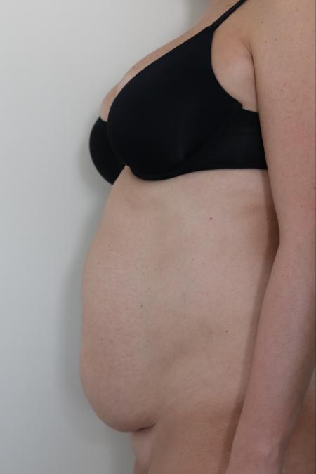 Before image 2 Case #122761 - Traditional Abdominoplasty
