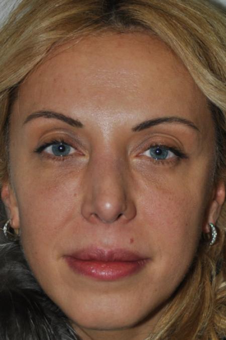 After image 1 Case #122731 - Revision Rhinoplasty