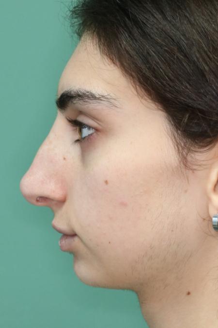 Before image 4 Case #122491 - Aesthetic Reduction Rhinoseptoplasty