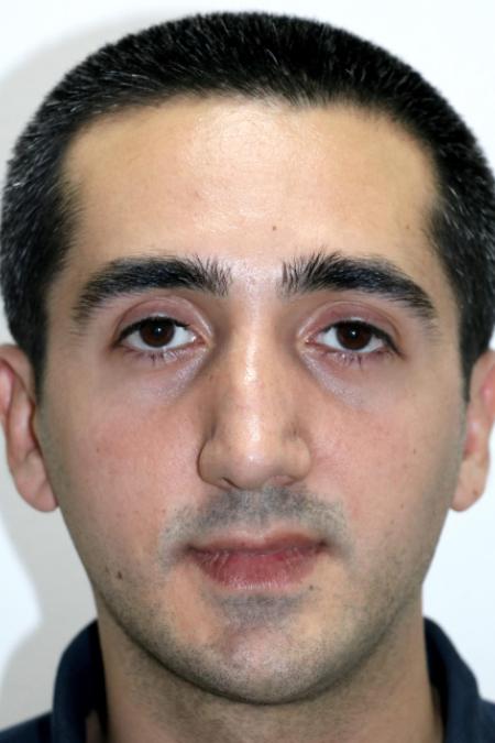 Before image 1 Case #122726 - Revision Rhinoseptoplasty, Turbinoplasty
