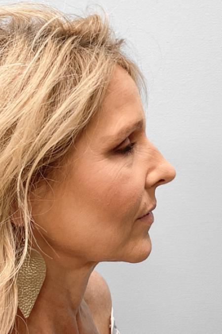 Before image 3 Case #123466 - Rhinoplasty