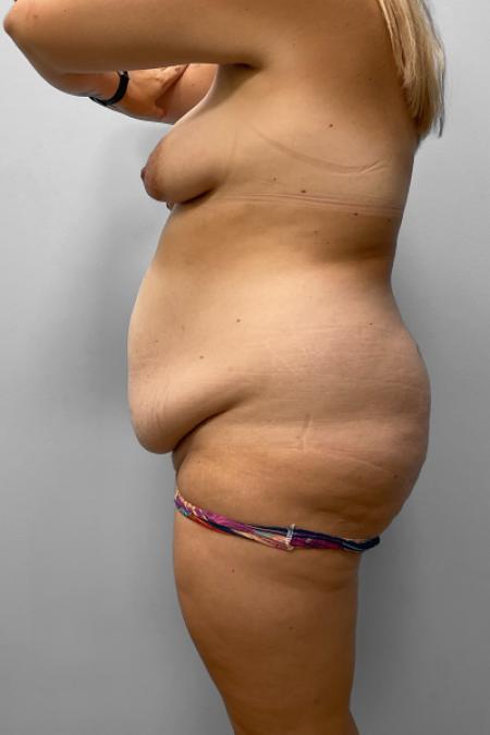 Before image 3 Case #123511 - Mommy Makeover