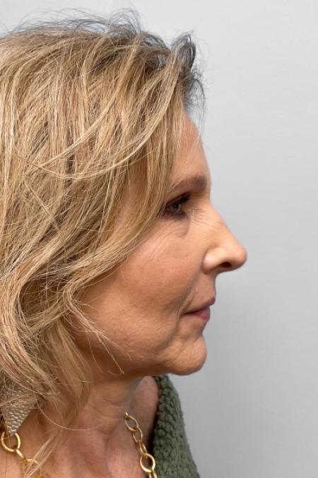 After image 3 Case #123466 - Rhinoplasty