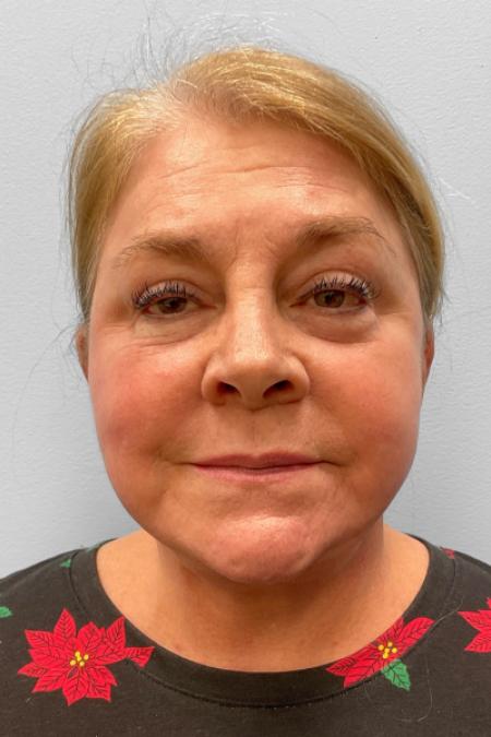 After image 1 Case #123521 - Facelift & Laser Resurfacing