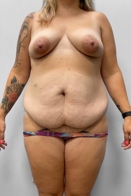 Before image 1 Case #123511 - Mommy Makeover