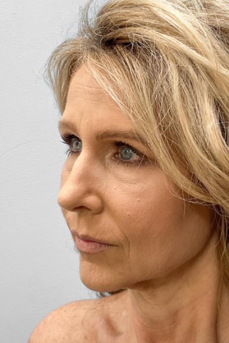 Before image 2 Case #123466 - Rhinoplasty