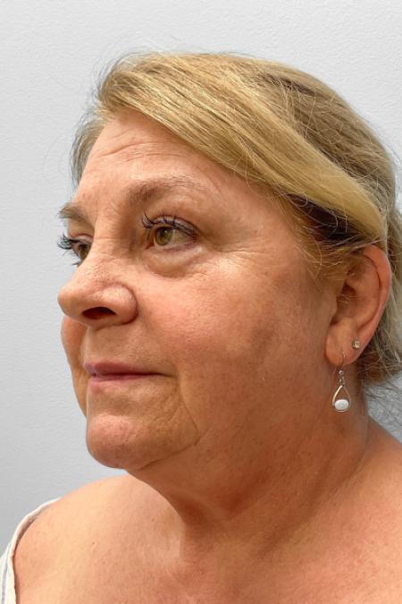 Before image 2 Case #123521 - Facelift & Laser Resurfacing