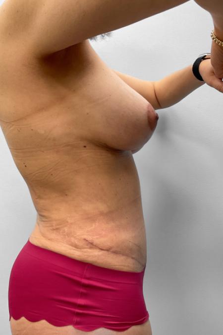 After image 3 Case #123476 - Mommy Makeover