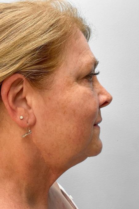 Before image 3 Case #123521 - Facelift & Laser Resurfacing