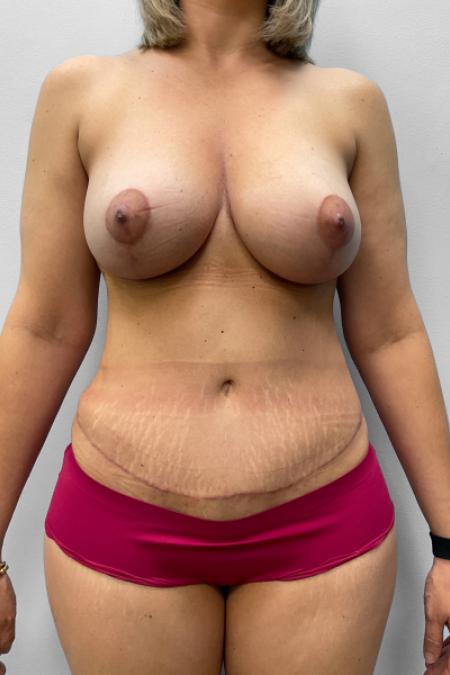 After image 1 Case #123476 - Mommy Makeover
