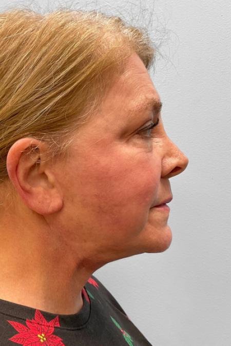 After image 3 Case #123521 - Facelift & Laser Resurfacing