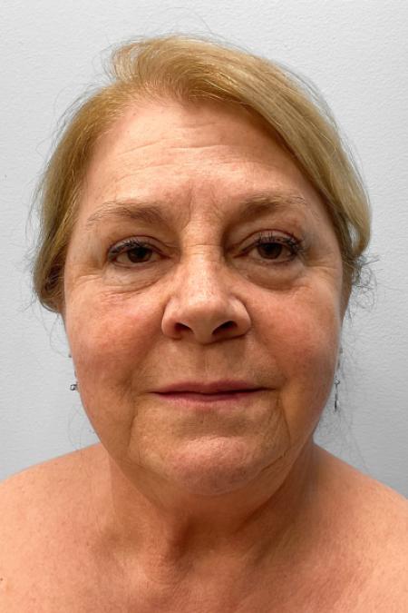 Before image 1 Case #123521 - Facelift & Laser Resurfacing