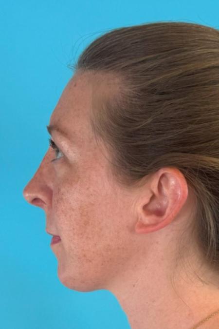 After image 3 Case #125116 - New nose - breathing better and looking better :)
