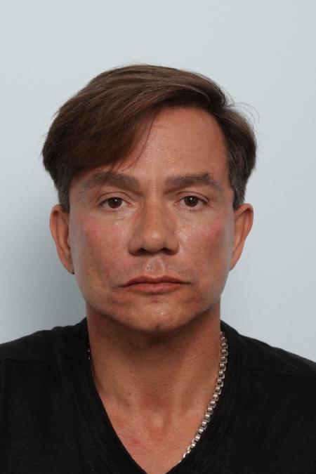 After image 1 Case #125846 - Facelift