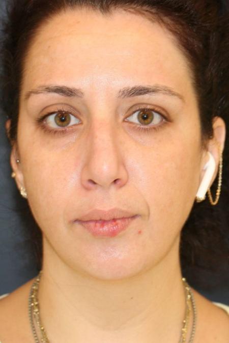 Before image 1 Case #126001 - Female Rhinoplasty Before image 1 Case #126001 - Female Rhinoplasty
