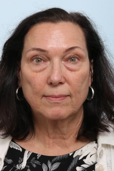 Before image 1 Case #125911 - Upper and Lower Blepharoplasty