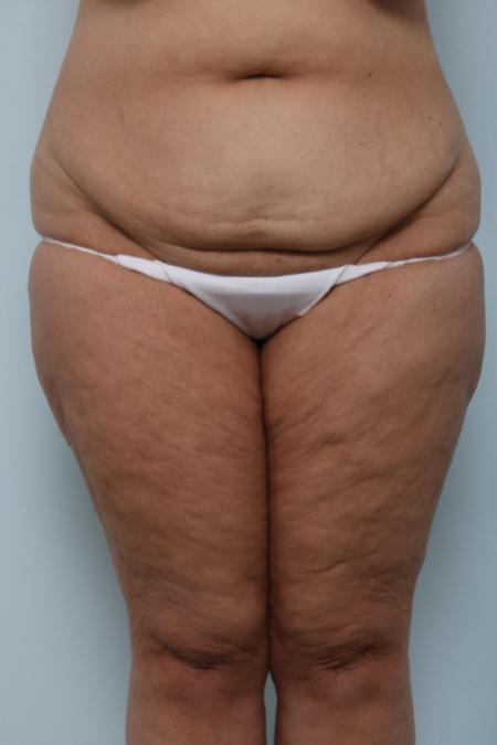 Before image 1 Case #125981 - Thigh Lift