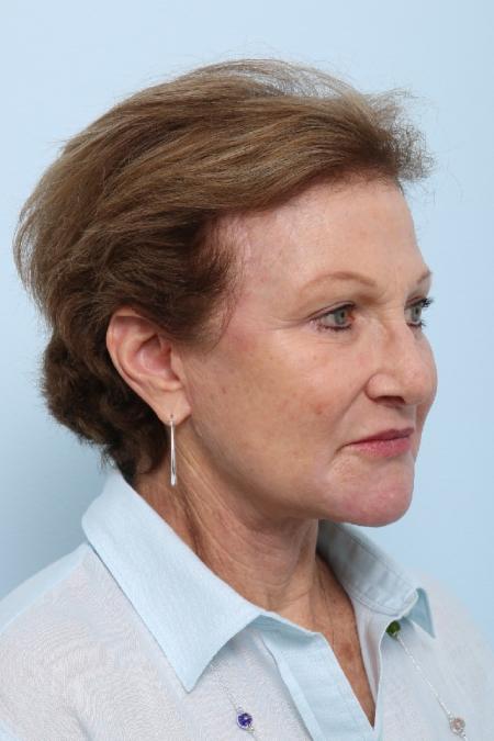 After image 2 Case #125851 - Facelift