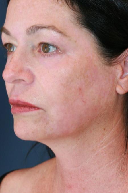 After image 2 Case #125656 - Co2 Laser Resurfacing