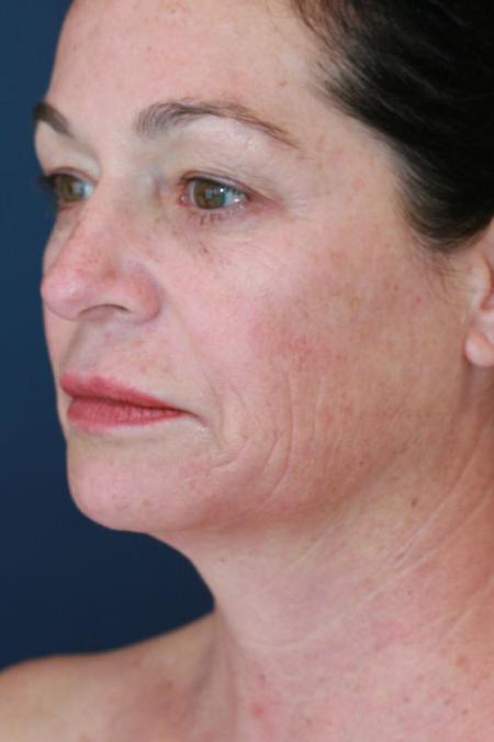 Before image 2 Case #125656 - Co2 Laser Resurfacing