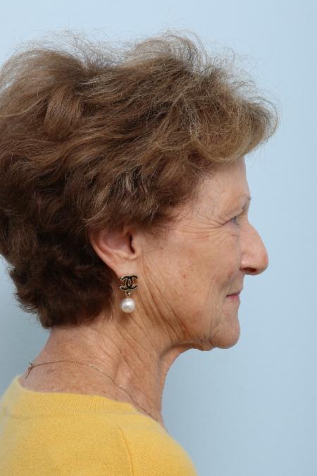 Before image 3 Case #125851 - Facelift