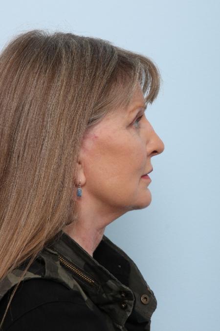 After image 3 Case #125861 - Facelift