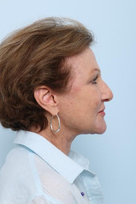 After image 3 Case #125851 - Facelift