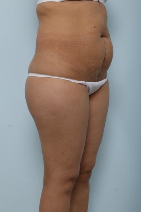 Before image 2 Case #125991 - Tummy Tuck Before image 2 Case #125991 - Tummy Tuck