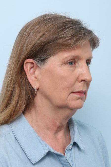 Before image 2 Case #125861 - Facelift