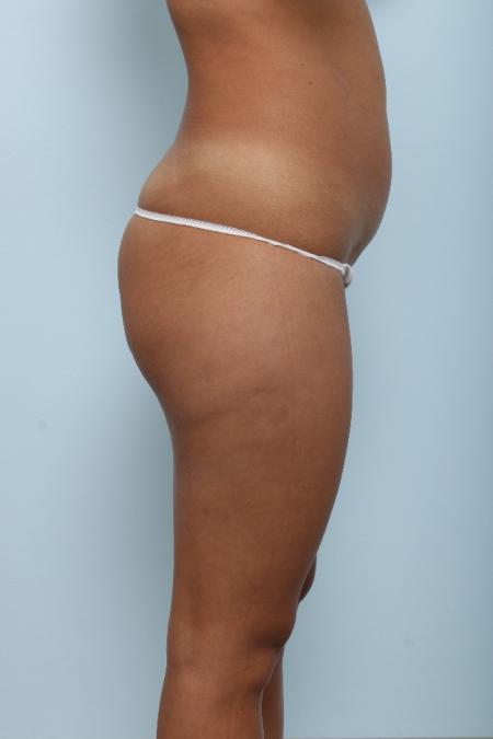 Before image 3 Case #125971 - Liposuction Before image 3 Case #125971 - Liposuction