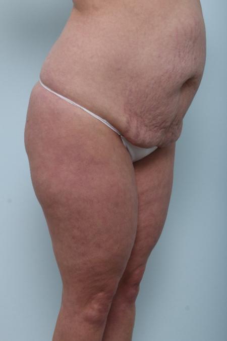Before image 2 Case #125956 - Tummy Tuck