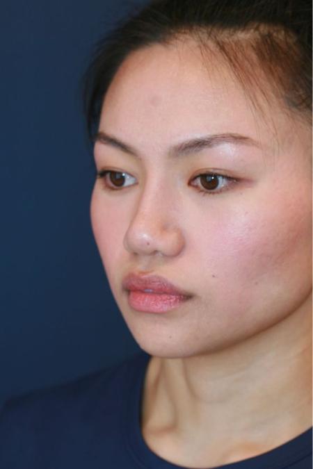 After image 2 Case #125676 - Open Rhinoplasty