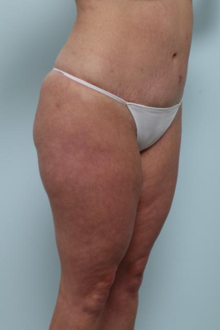 After image 2 Case #125956 - Tummy Tuck