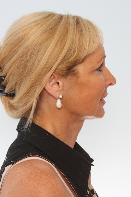 After image 3 Case #125856 - Facelift