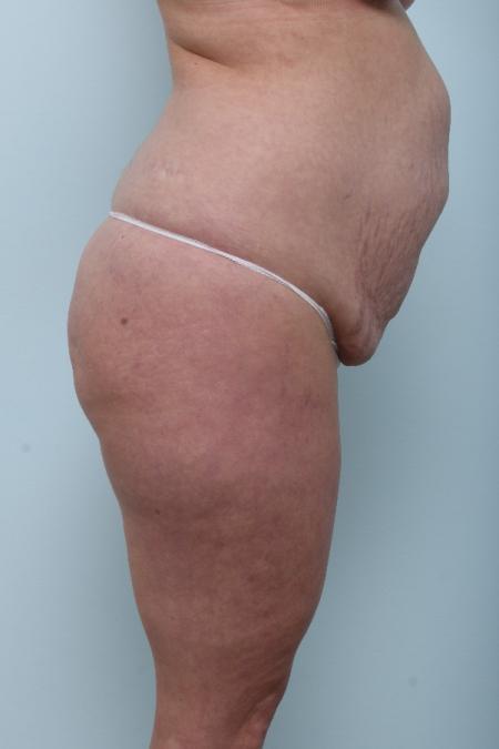 Before image 3 Case #125956 - Tummy Tuck