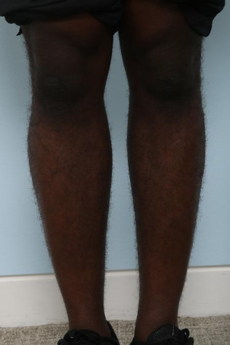 After image 1 Case #125946 - Calf Implants